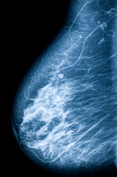 Breast cancer scan